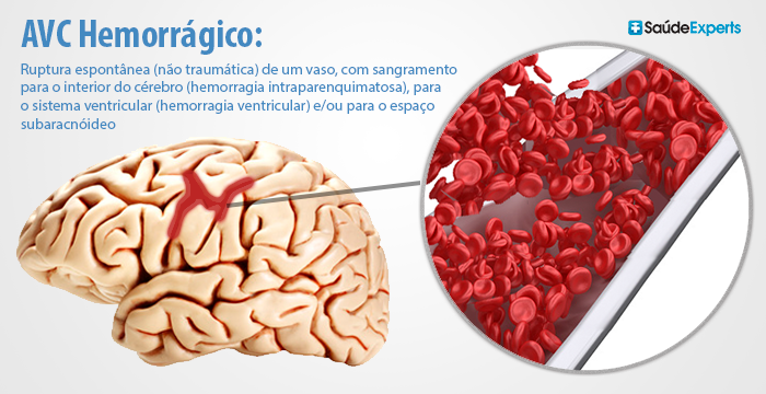 Hemorragia Cerebral Sintomas Tipos Intraparenquimatosa 7088