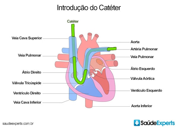 Introdução do cateter - coração