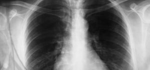 DPOC - Doença Pulmonar Obstrutiva Crônica